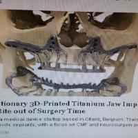 3D-Printed Titanium Implant 