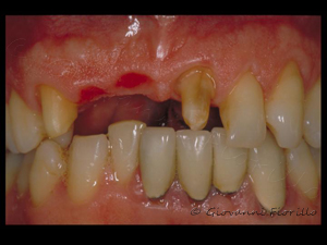 Preparazione di elementi dentali per riabilitazione in lega nobile bioinerte e ceramica copia