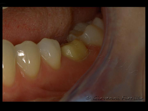 Giovanni Fiorillo   Zahndesign GmbH Protesizzazione di molare inferiore in lega nobile bioinerte e ceramica
